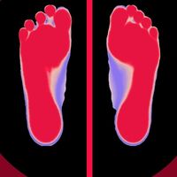足底筋膜炎：一个月从疼痛难忍到逐步缓解，我做了这些