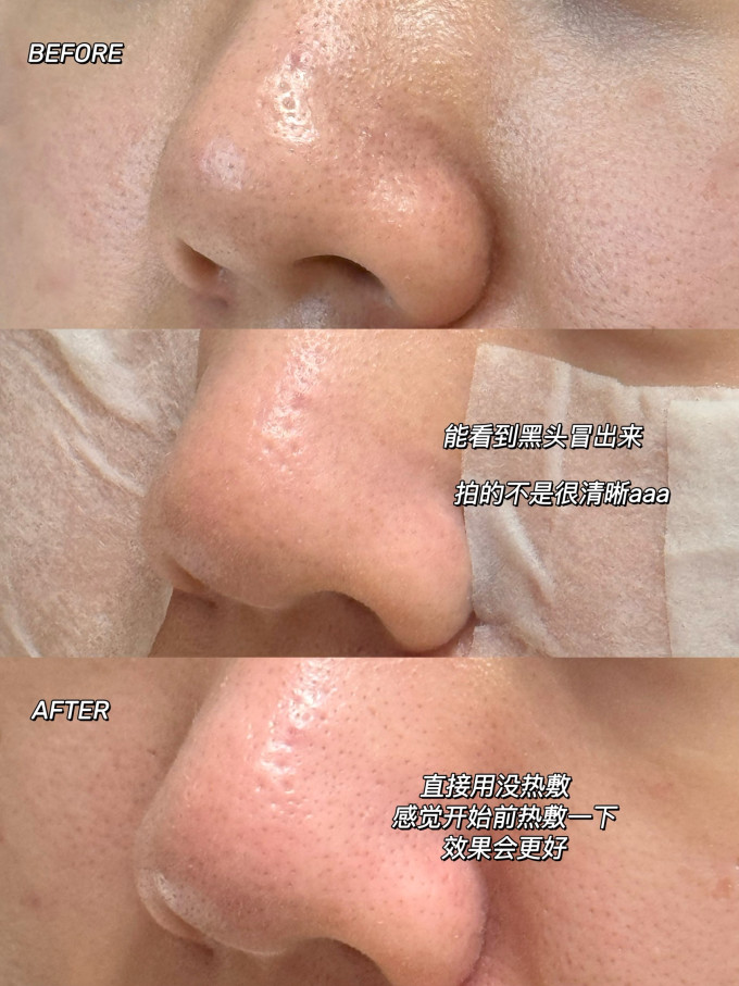 黑头导出液