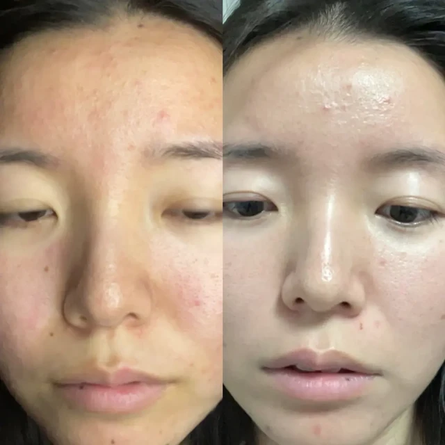 分享我成功的祛痘经历