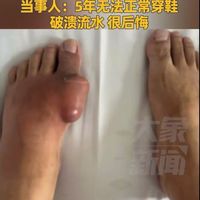 40岁男子因长期喝碳酸饮料 脚上长6cm痛风石 5年无法正常穿鞋