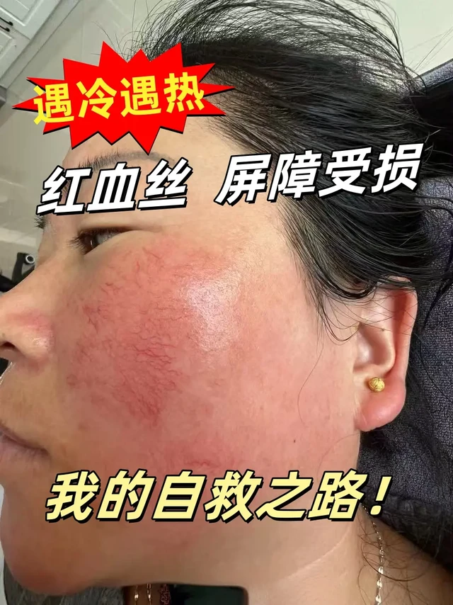 SOS！烂脸自救成功！红血丝女孩自救指南！