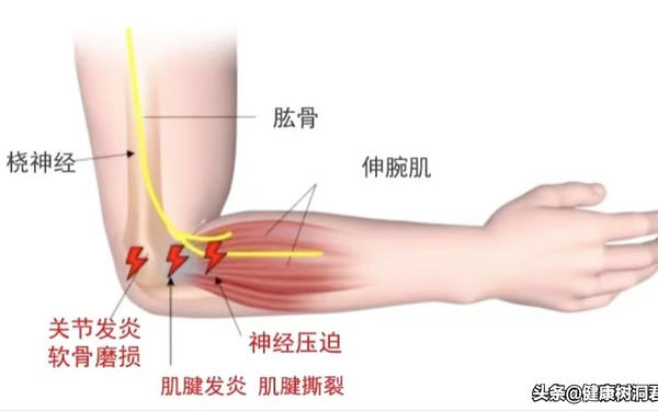 打网球才会得网球肘？错！抱娃、刷手机的人一样也会中招