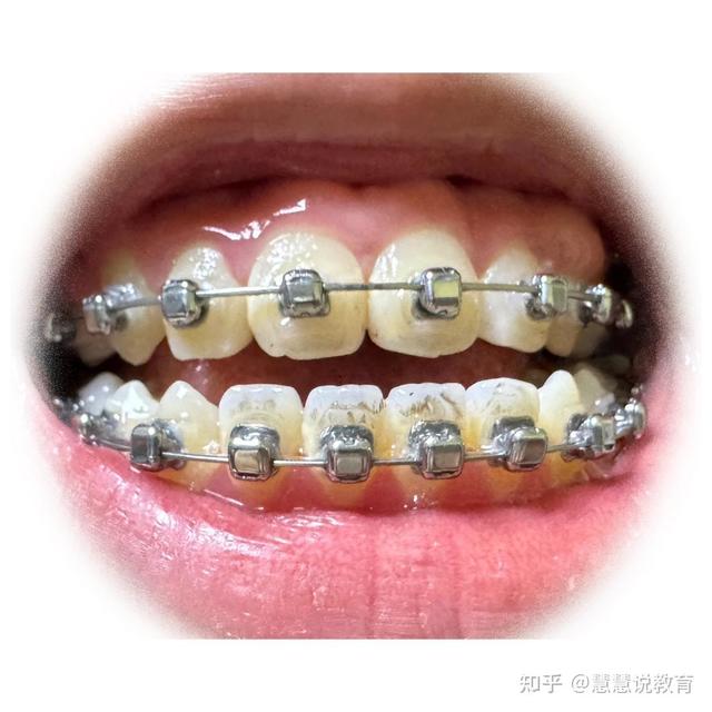 想问下有经验的宝妈，都给孩子选什么牙膏？
