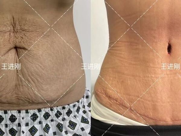 腹壁成形术后注意事项：疤痕护理指南