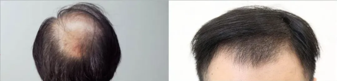 秋天头发掉到怀疑人生,这4种脱发情况还有救!
