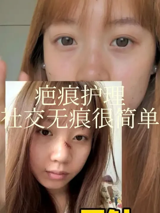 疤痕初期真的很重要，一定要重视起来呀，宝宝们问的#美皮护 今天挂在左下角啦！#切痣 #疤痕护理