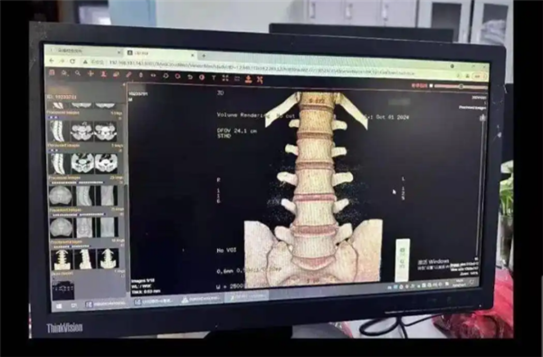 小伙学冲浪闪了腰致截瘫:确诊罕见病“冲浪者脊髓病”
