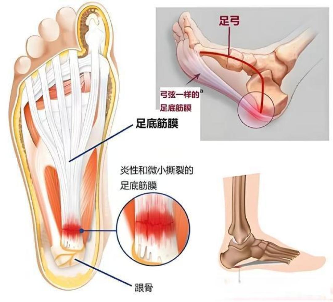 这六个手法彻底释放你的足底筋膜，让你“足”够轻松！