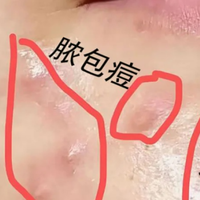谁懂啊！喝一个月！下巴脸颊终于不冒痘了！