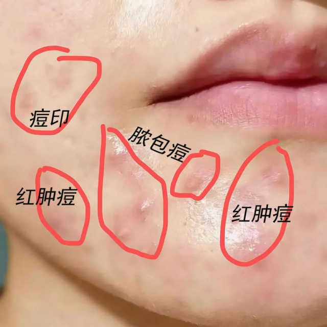 谁懂啊！喝一个月！下巴脸颊终于不冒痘了！