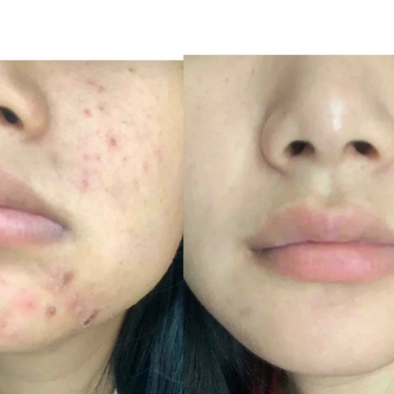 战痘六年经验分享，靠护肤、医美都不行的家人们，试试内调！