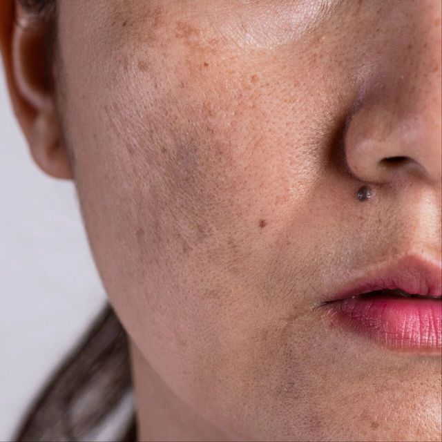 为什么人到中年爱长斑？当我决定与它和解，它却淡了......