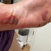 女子踩指压板20分钟脚底喷血！专家揭使用风险与正确注意事项