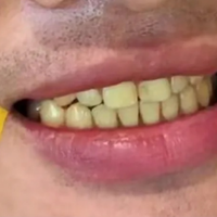 因为烟渍牙差点分手...说说我是怎么刷掉陈年大黄牙的！