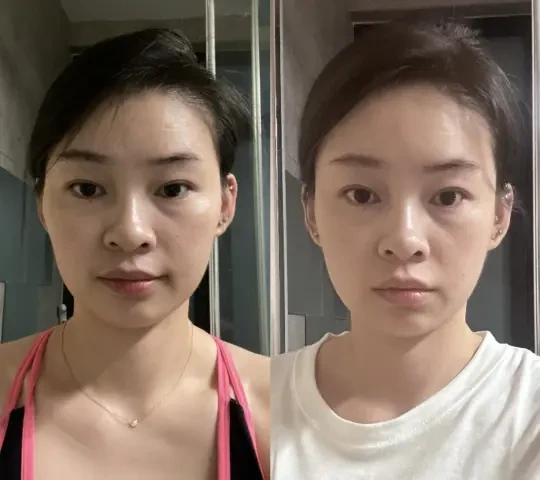 33岁，替大家试过了，补镁早睡+压颧骨真治垮