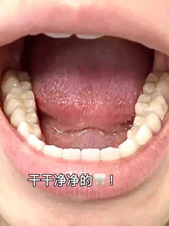 不想再洗牙受罪…牙结石真得预防起来！