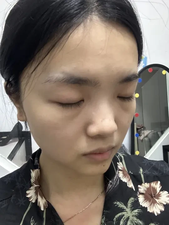 童颜氺光+光子打完一周，说下感受
