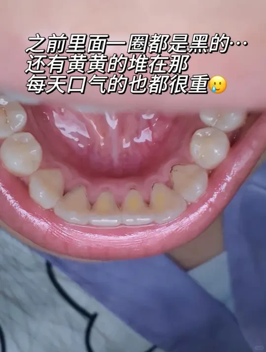 别再盲目洗牙了！！牙缝变大 牙敏感谁懂！
