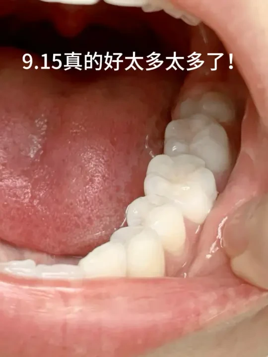 牙结石不用去🏥，自己在家就能清理