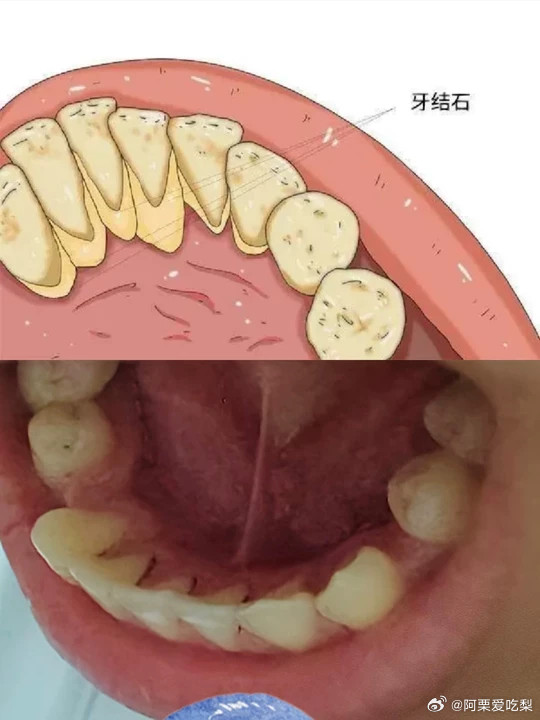 牙齿上堆满了牙菌斑/牙垢/牙渍，牙也很黄，怎么改善？一个牙粉，五十多块钱牙齿角角落落，牙菌斑、牙渍、牙垢通通拿捏，最关键的是，不伤牙！不刺激！不反复！要知道，牙菌斑、牙垢、牙渍的形成实际上是一个递进关