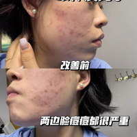 精准狙击痘痘粉刺 黛熙梦净颜祛痘焕肤精华液成油痘肌本命好物