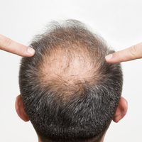 米诺地尔与非那雄胺治脱发，谁更有效？850+用户观点大PK