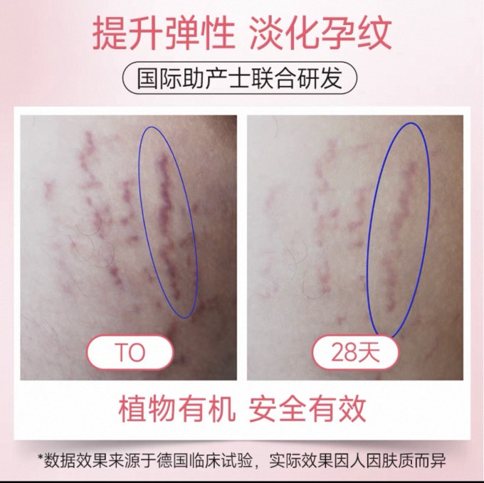 维蕾德妊娠按摩膏