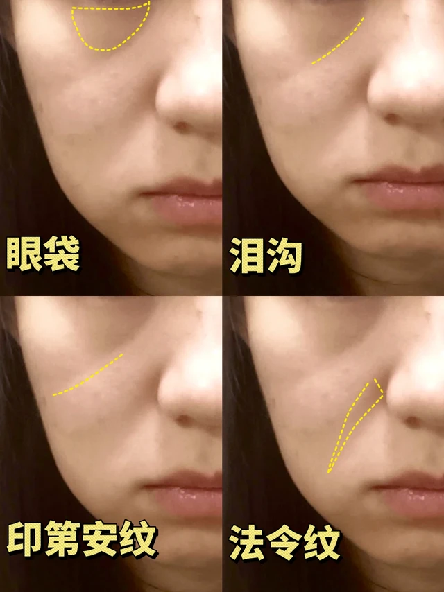 眼袋 泪沟 印第安纹 法令纹，你分清了