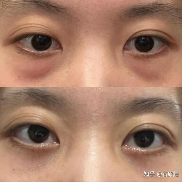 脂肪型眼袋还有救吗？德玛森氏说是医生联合创办的品牌，对抗眼袋的思路靠谱吗？德玛森氏 UP21 眼精华到底怎么样？