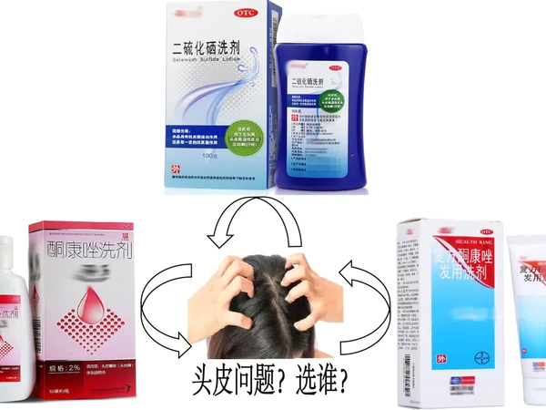 二硫化硒和酮康唑或复方洗剂？--带你选择