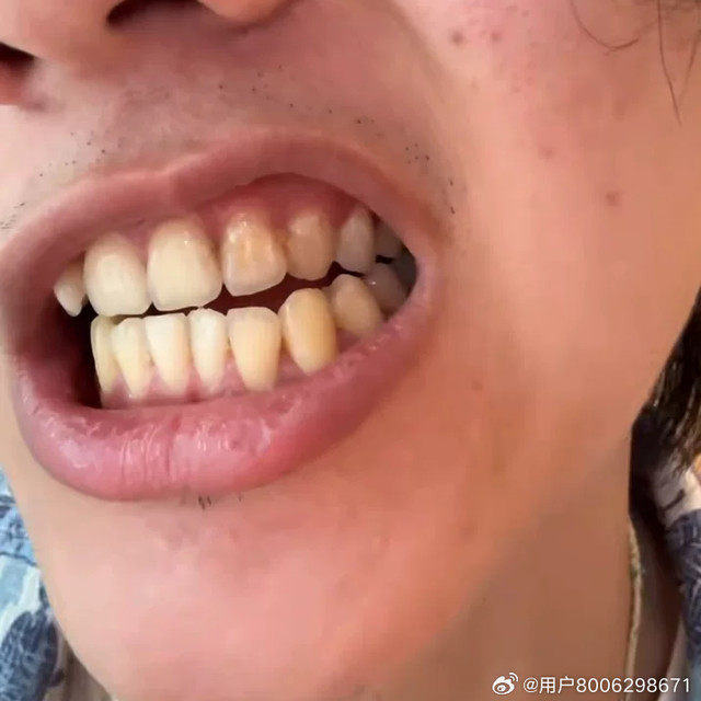 你有试过用手把牙结石抠出来吗？没必要，容易流血让牙缝变大、有个国产的微米级牙粉，几十块钱，溶解松动之后刷出来一颗一颗排排队，不比用手扣爽吗？（这是一篇有味道的文章，吃饭禁看！）不知道你们对象是不是和我