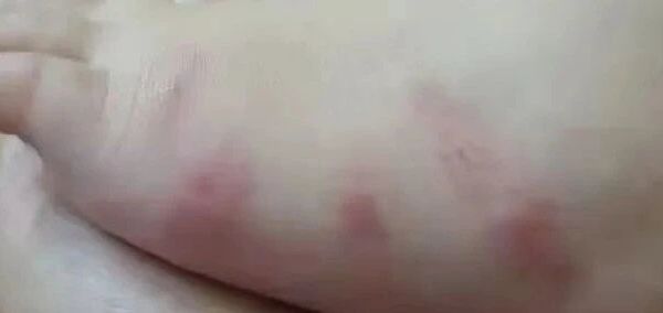 常见皮肤问题，一文教你在家解决！避免去医院！