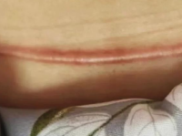 剖腹产疤痕护理实录｜坚持这三步，增生疤痕真的平了！
