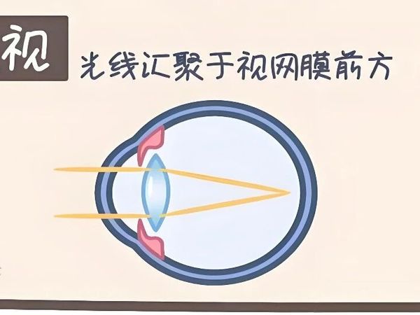 孩子近视配镜不纠结！防控镜片到底怎么选？