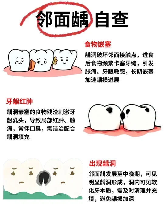 邻面龋自查！一定要用防蛀牙线预防！