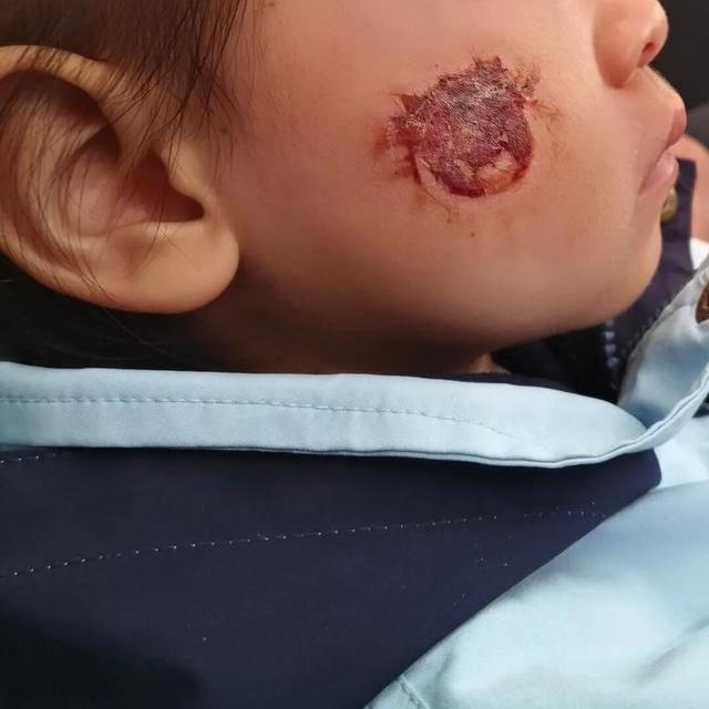 湖南一3岁女童因贴贴纸后脸部糜烂，家长：一开始是轻微红斑，几天后，红斑迅速扩大，红肿加剧并冒出水疱