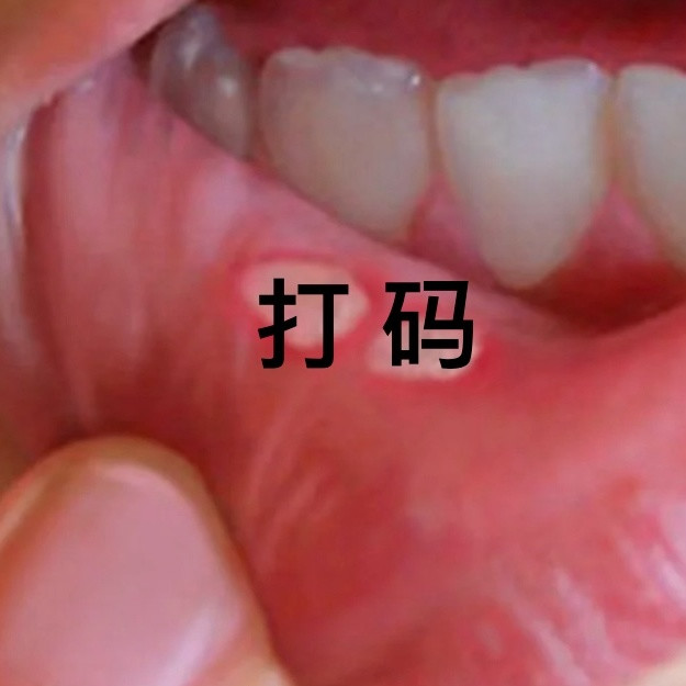 导致口腔溃疡、黏膜脱落的居然是牙膏？！90%的牙膏都含这个“危险”成分