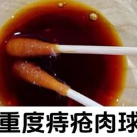 一个对重度痔疮肉球消除很管用的法子！