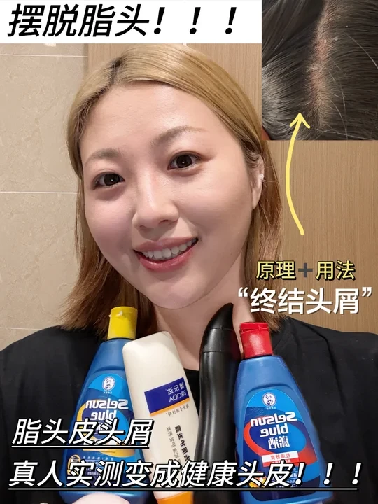 脂溢性皮炎头皮各种问题看这一个视频就够！