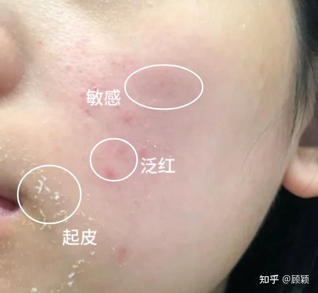 扒一扒孕期敏感肌秋冬季最爱的8款孕妇面膜！想要修复、补水、提亮的孕妈可以照着买！