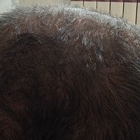 谢顶，脱发可以试试它