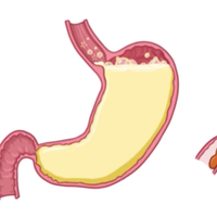 抑酸剂 vs 黏膜保护剂？我们汇总了127位用户真实用药体验，答案在这