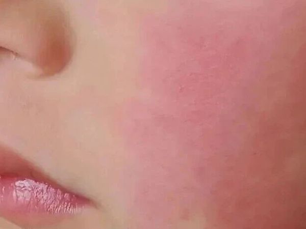身上干痒起皮，越挠越红？小心是这里“漏风”了