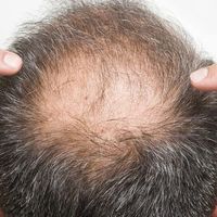 米诺地尔泡沫剂真能高效生发？587+用户观点大碰撞