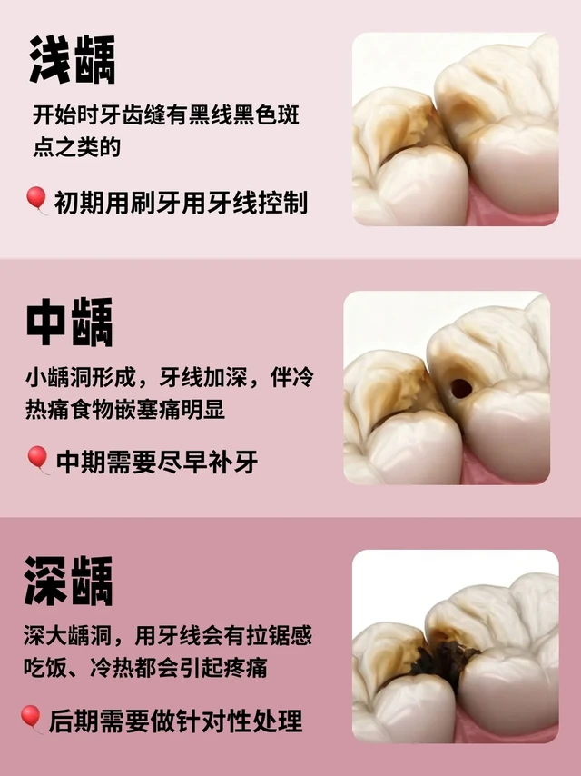 牙齿出现黑斑别拖！！不用防蛀牙线小心邻面