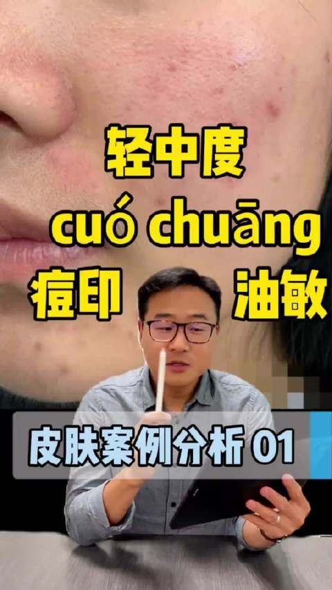 #彩妆产品##微博兴趣创作计划##东方之美# 结合多年护肤经验与法国护肤品店工作心得,为油敏痘肌整理了一套详细护肤方案:清洁选SVR舒缓控油洁面啫喱,舒缓用理肤泉喷雾,精华推荐SVR AZ,局部祛痘