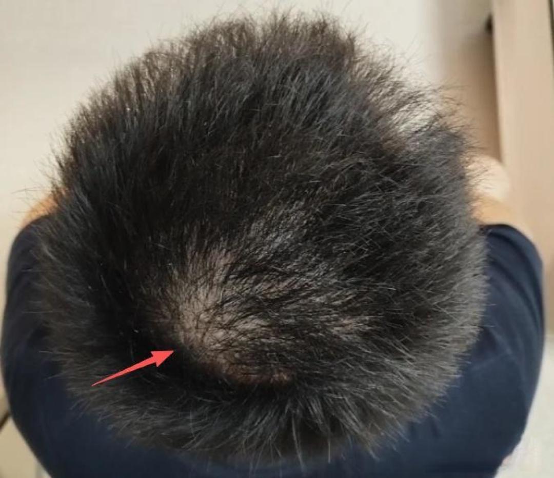 身体疲惫,头发先“报警”:揭秘身体的“牺牲”自保机制