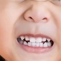 孩子磨牙别大意，“后遗症”既毁颜又伤牙，3种磨牙类型要懂识别