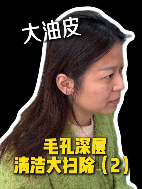 大油皮，毛孔深层清洁！20天反馈来了，大家觉得变化大吗？ #油皮  #毛孔清洁  #油痘肌  #护肤