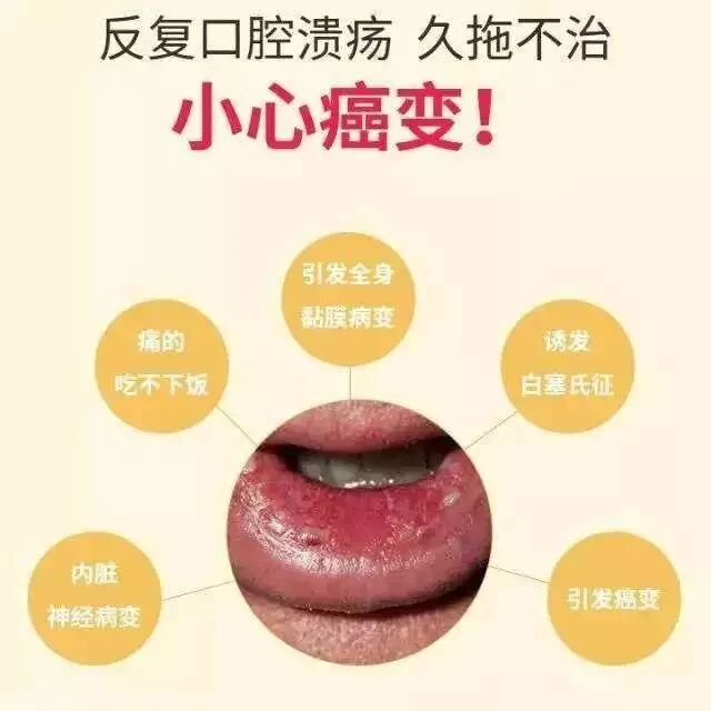 口腔溃疡的用药原则及6个联合用药方案！